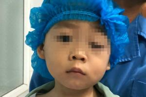 Cháu bé 2 tuổi bị sụp mi bẩm sinh gây nhược thị